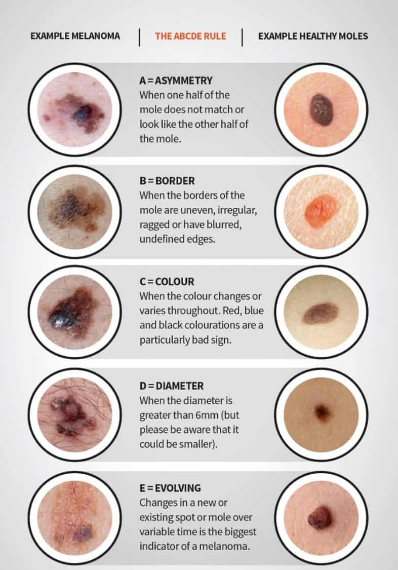 Black Dot On Skin Not Cancer